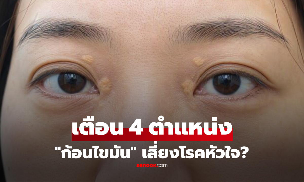 ไม่ใช่แค่เปลือกตา! เผย 4 ตำแหน่ง "ก้อนไขมัน" เสี่ยงโรคหัวใจ-คอเลสเตอรอลพุ่ง?