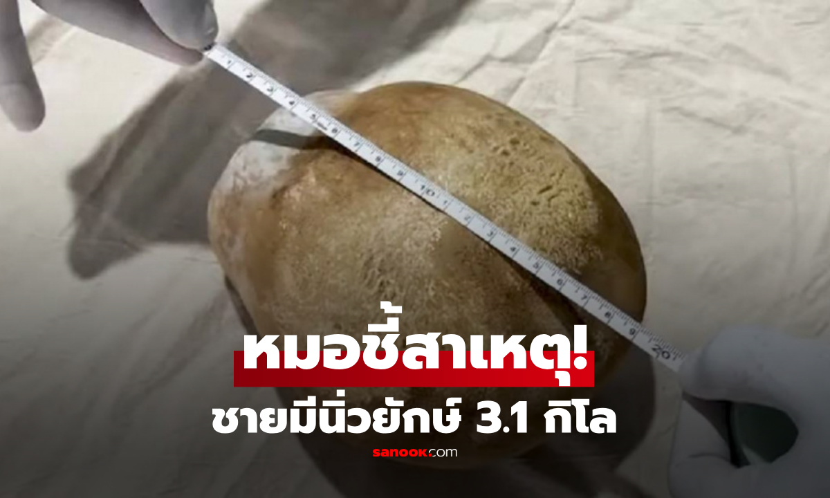 ชายช็อก! พบนิ่วยักษ์หนัก 3.1 กิโล หมอเผย "สาเหตุ" คาดอยู่ในร่างกายมากว่า 5 ปี