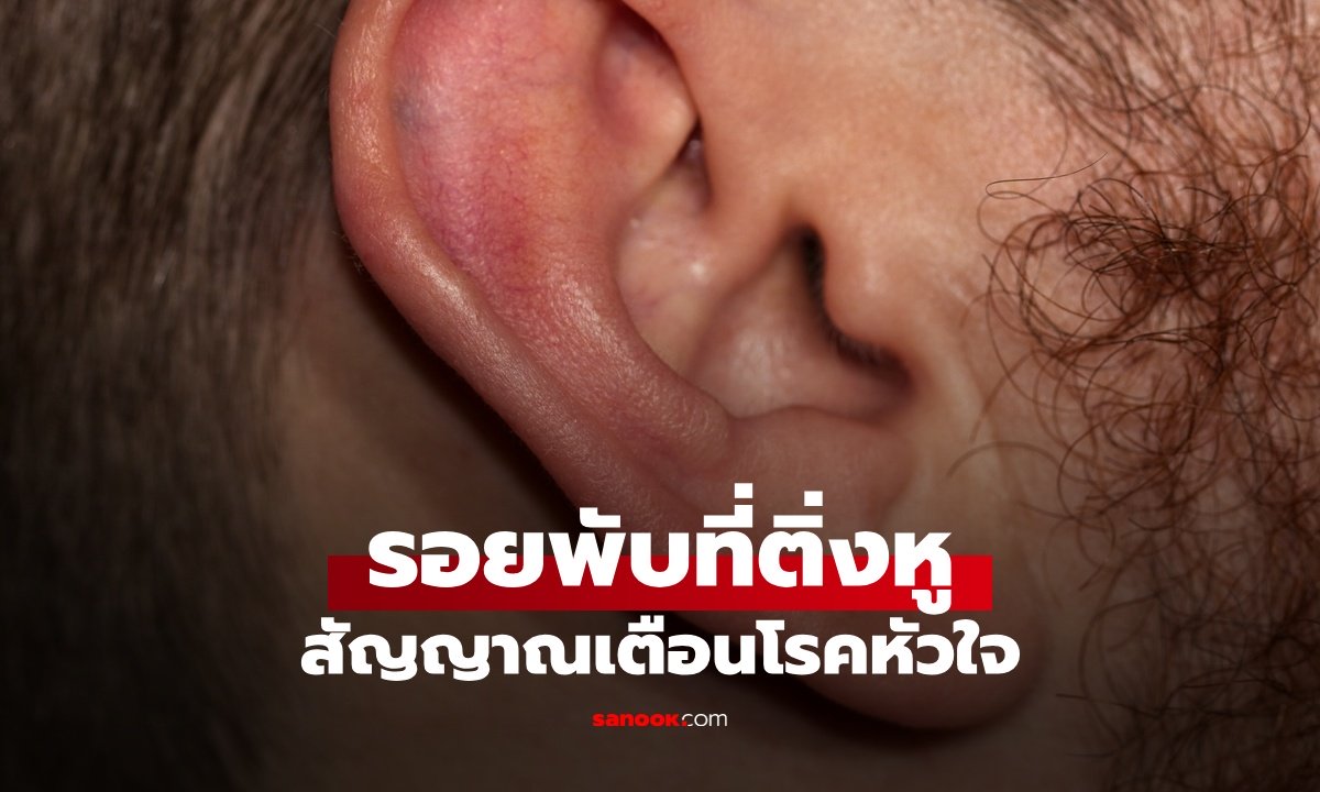 รอยพับที่ติ่งหู Frank’s Sign ทำนายโรคหัวใจ-เส้นเลือดหัวใจตีบ ได้จริงหรือไม่?