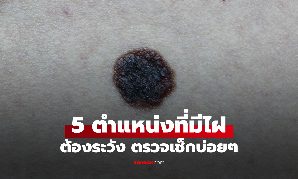 5 ตำแหน่งในร่างกาย หากมี "ไฝ" ต้องระวัง ตรวจเช็กบ่อยๆ ก่อนกลายเป็นข่าวร้าย
