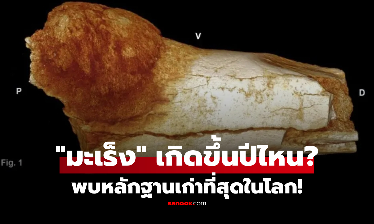 ไม่ใช่โรคยุคใหม่! "มะเร็ง" ถูกค้นพบตั้งแต่เมื่อไร? ย้อนดูหลักฐานเก่าแก่ที่สุดในโลก