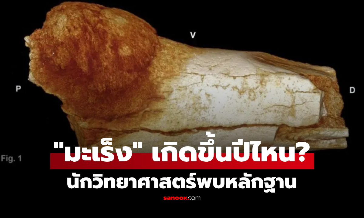 ไม่ใช่โรคยุคใหม่! "มะเร็ง" ถูกค้นพบตั้งแต่เมื่อไร? ย้อนดูหลักฐานเก่าแก่ที่สุดในโลก