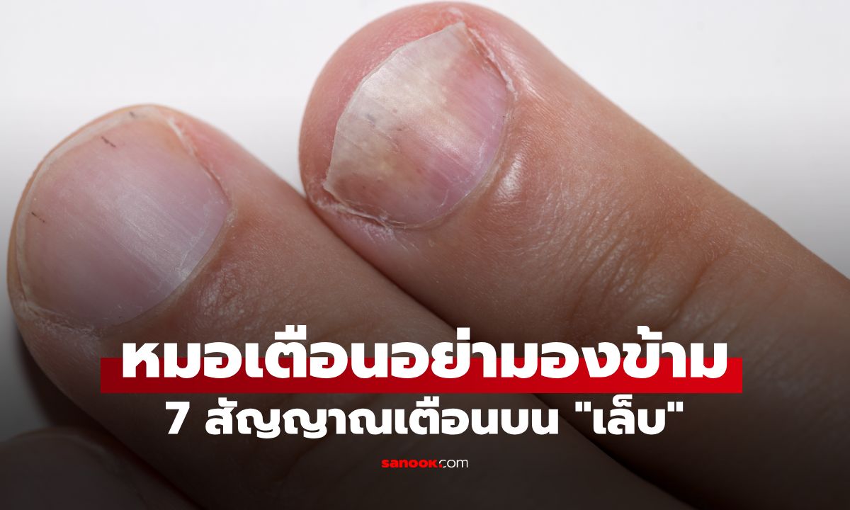 เช็กด่วน! 7 สัญญาณเตือนบน "เล็บ" บอกเบาะแสโรคร้าย แพทย์เตือนอย่ามองข้าม