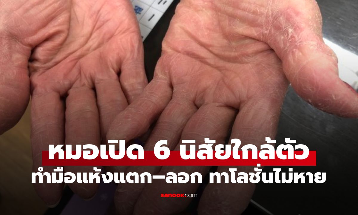 มือแห้งแตกลอก ทาโลชั่นเท่าไหร่ก็ไม่หาย! หมอเปิด 6 นิสัยทำผื่นอักเสบกำเริบ