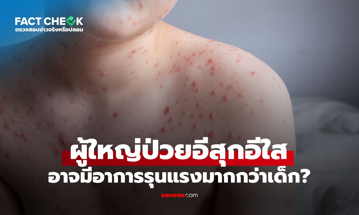 ผู้ใหญ่เป็นอีสุกอีใส อาการรุนแรงกว่าเด็กจริงไหม? กรมควบคุมโรคมีคำตอบ : เช็กข่าวชัวร์