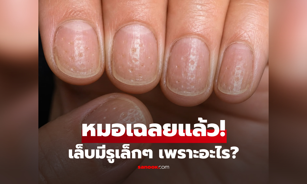เล็บคุณมีรูเล็กๆ? แพทย์ชี้เป็นสัญญาณเตือน ‘โรคนี้‘ อย่าคิดแค่ขาดแคลเซียม!
