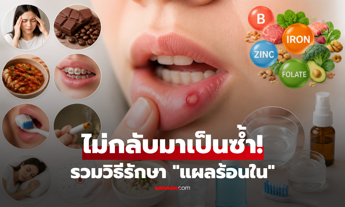 "แผลร้อนใน" เกิดจากอะไร? รวมวิธีป้องกัน-รักษาให้หายไว ไม่กลับมาเป็นซ้ำ!