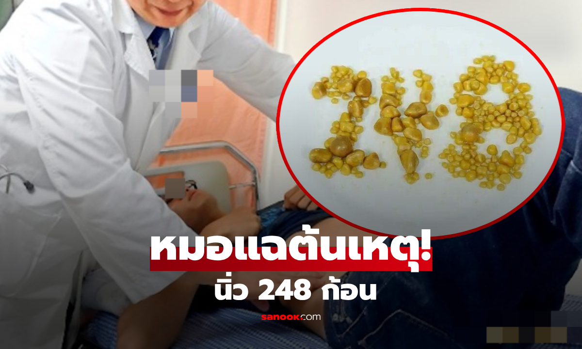 หนุ่มอายุน้อย ช็อก! "นิ่วในถุงน้ำดี" 248 ก้อน หลังใช้ชีวิตกินตามใจ คนรุ่นใหม่ต้องระวัง!