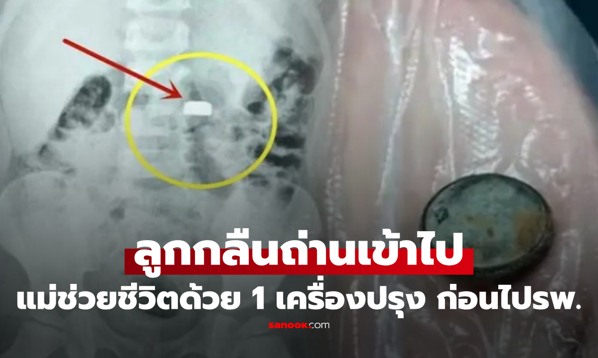 เด็ก 3 ขวบ กลืน "ถ่านกระดุม" เข้าไป แม่รู้รีบป้อน "1 เครื่องปรุง" ก่อนพาไป รพ. ช่วยชีวิตลูกสำเร็จ!