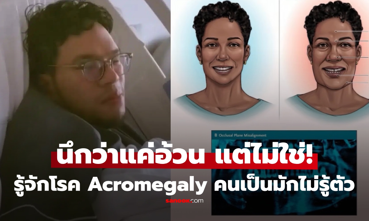 Acromegaly คืออะไร? รู้จักโรคแปลก ไม่ใช่อ้วน แต่อวัยวะโตขึ้นผิดปกติ หลายคนเป็นไม่รู้ตัว!