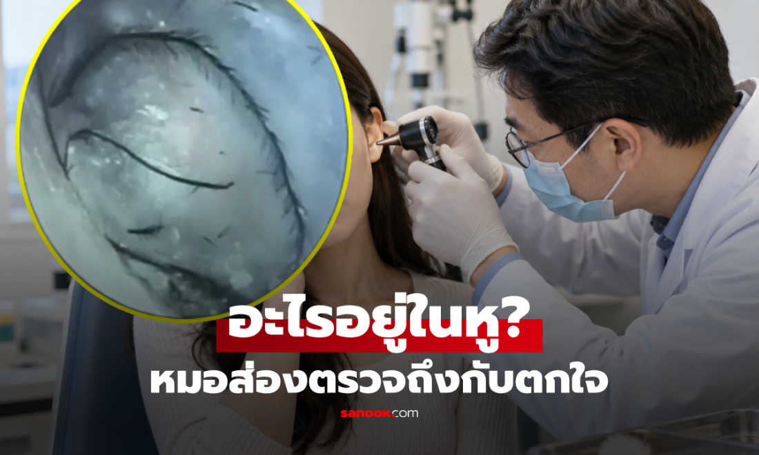 สาววัย 29 คันหูหนัก หมอส่องตรวจถึงกับตกใจ พบ "สิ่งนี้" ติดใกล้แก้วหู!