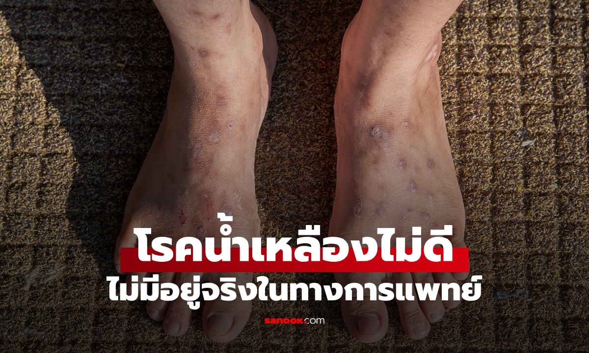 เข้าใจซะใหม่ "โรคน้ำเหลืองไม่ดี" ไม่มีอยู่จริงทางการแพทย์ เผยสาเหตุผิวเป็นตุ่มคันพุพอง