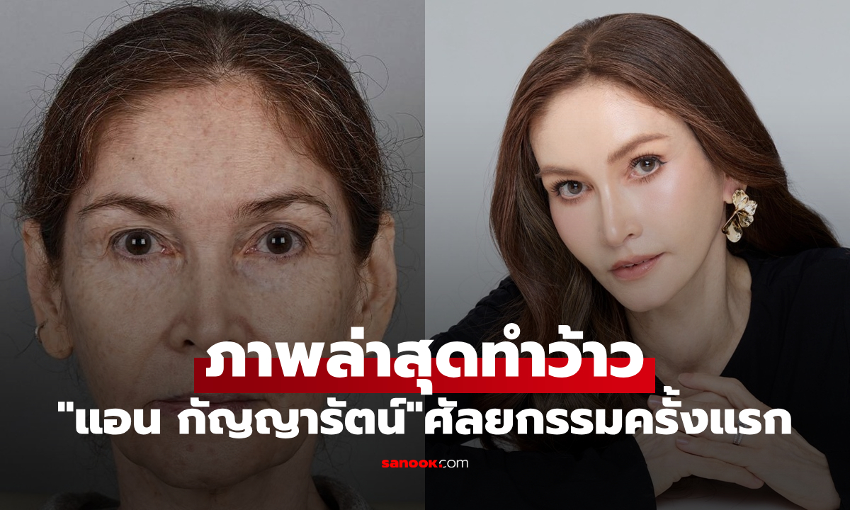 "แอน กัญญารัตน์" วัย 60 ปี ศัลยกรรมครั้งแรกในชีวิต เผยภาพล่าสุดทำว้าวเลย
