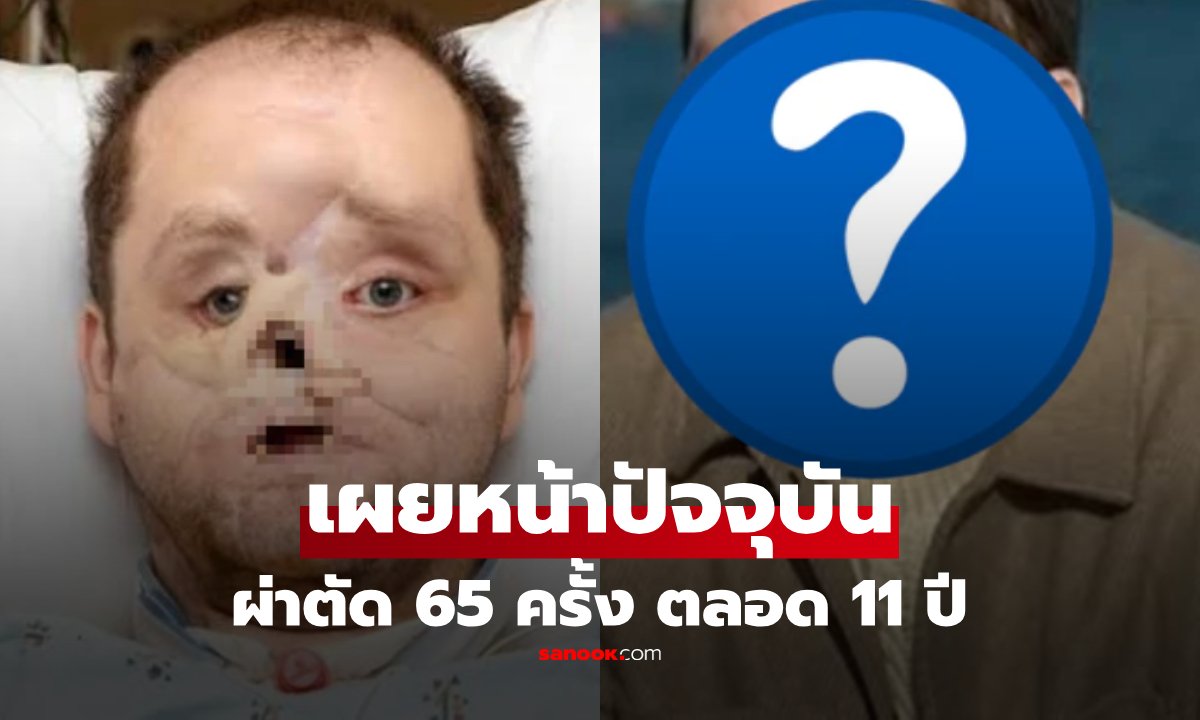 เปิดรูปล่าสุด "ชายผู้สูญเสียใบหน้า" ผ่าตัด 65 ครั้ง ตลอด 11 ปี ก่อนกลับมายิ้มได้