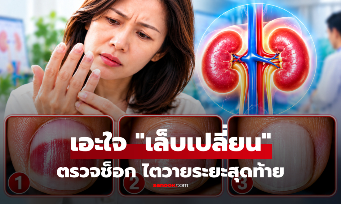 พนง.ออฟฟิศ เอะใจ "เล็บเป็นแบบนี้" ไปตรวจยิ่งช็อก ไตวายระยะสุดท้าย!