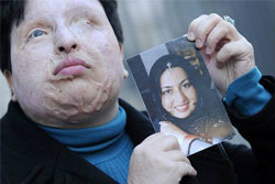 หญิงอิหร่าน ไม่แก้แค้น หนุ่มคลั่งรักสาดน้ำกรด