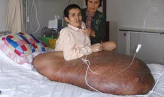 โรคประหลาดเนื้องอกที่ขาขนาดใหญ่ 90 กก.