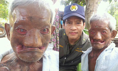 ลุงวัย 65 ป่วยโรคประหลาด ใบหน้าคล้ายยักษ์