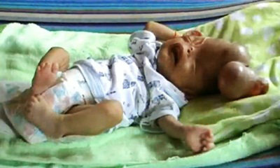 เด็กชายเดือนเศษ เกิดมาสมองอยู่นอกกะโหลก