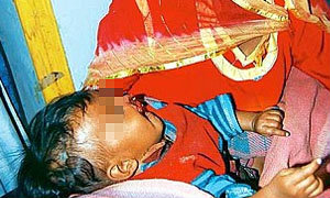 พ่ออินเดียคลั่ง กัดจมูกปากลูกสาว 5 เดือน จนฉีก