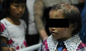 พ่อใจโหดเย็บปากลูกสาวด้วยเบ็ดตกปลาจนขาดสารอาหาร