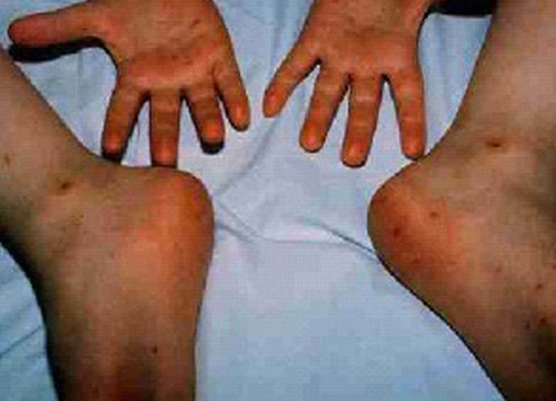 มือเท้าปากระบาดพบป่วย2.7หมื่นรายดับ1ราย