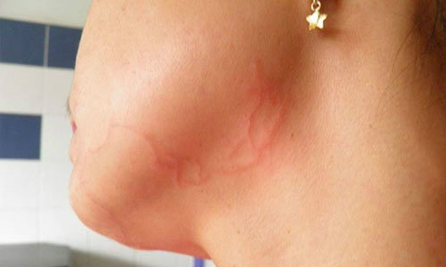 ชาวเน็ตตื่น! สาวถูกพยาธิไชใบหน้า หลังกินตำปูปลาร้า