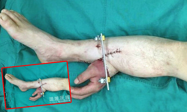 สุดเหลือเชื่อ! ผ่าตัดพิสดาร"เย็บมือคนไข้ขาด"ไว้ที่เท้า ก่อนรักษาได้อย่างฉลุย