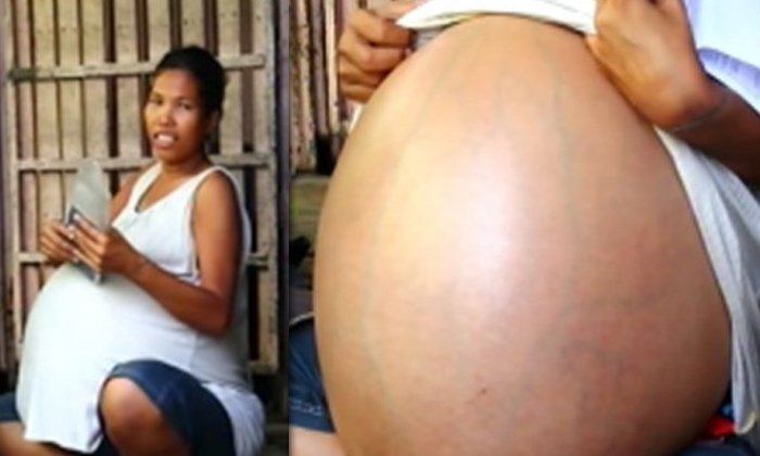 หมอไทยผ่าตัด สาวท้องไม่คลอด 2 ปี พบก้อนเนื้อหนักกว่า 30 กก.