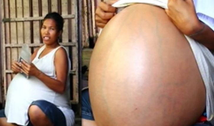 หมอไทยผ่าตัด สาวท้องไม่คลอด 2 ปี พบก้อนเนื้อหนักกว่า 30 กก.