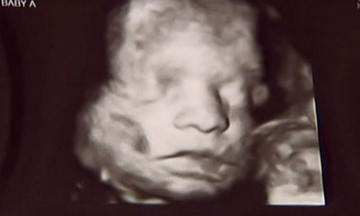 น้ำตาซึม! ทารกแฝดในครรภ์ "กุมมือกัน" เพราะหนึ่งในนั้นอาจไม่รอดชีวิต