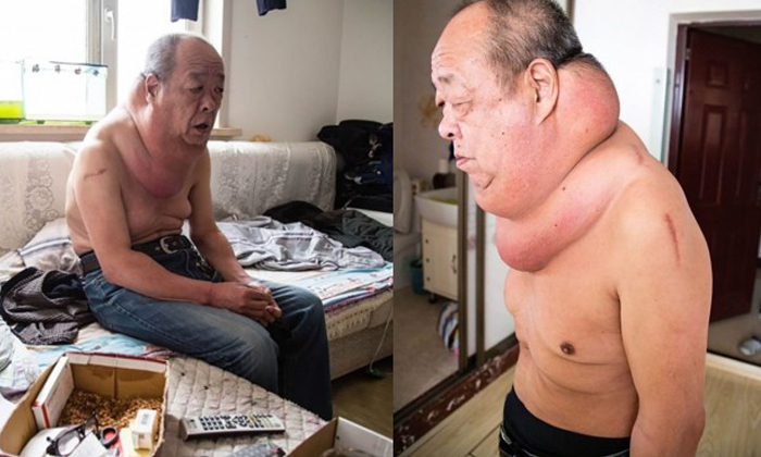 ชายจีนแบกก้อนเนื้องอกยักษ์ที่คอกว่า 13 ปี เพราะไม่มีเงินผ่าตัด