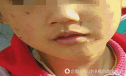 สลด เด็กหญิงจีน 6 ขวบถูกแม่ทำร้าย กระชากผมหลุดเป็นกระจุก