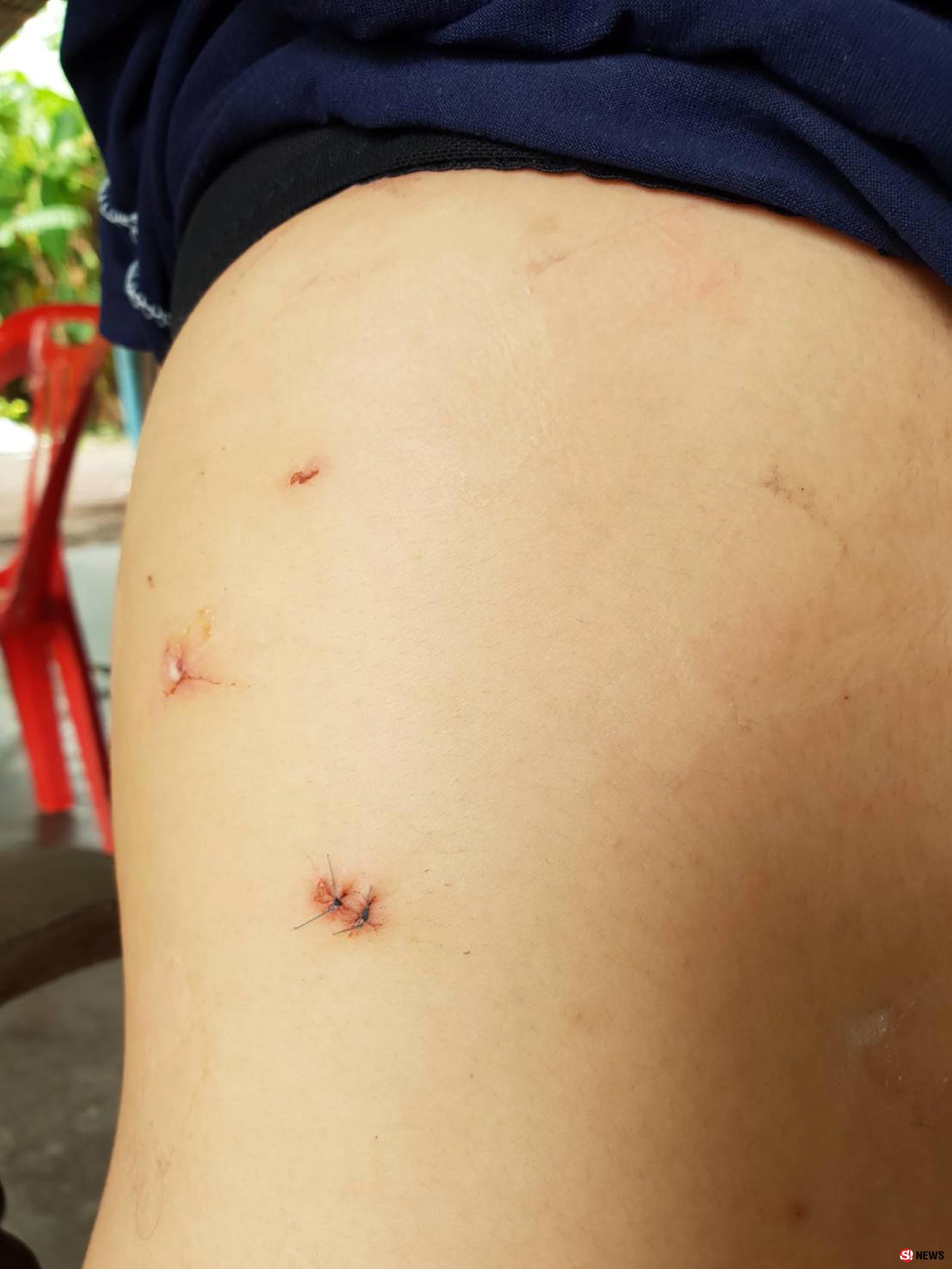 จับผัวอำมหิต! ทาสยาบ้าเสพวันละ 10 เม็ด หลอนจัดทุบตี-มีดกรีดหน้าแฟนสาวทั้งที่ตั้งครรภ์
