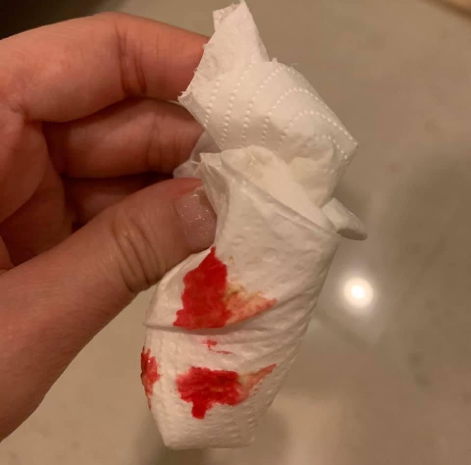 ได๋ ไดอาน่า เลือดกำเดาไหล