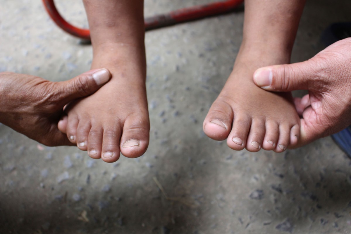 ราชบุรี (สิริมงคล) ส่ง - พบเด็กแปลกมีนิ้วมือนิ้วเท้ารวม 24 นิ้ว