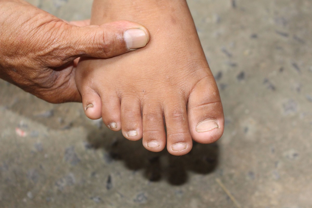 ราชบุรี (สิริมงคล) ส่ง - พบเด็กแปลกมีนิ้วมือนิ้วเท้ารวม 24 นิ้ว