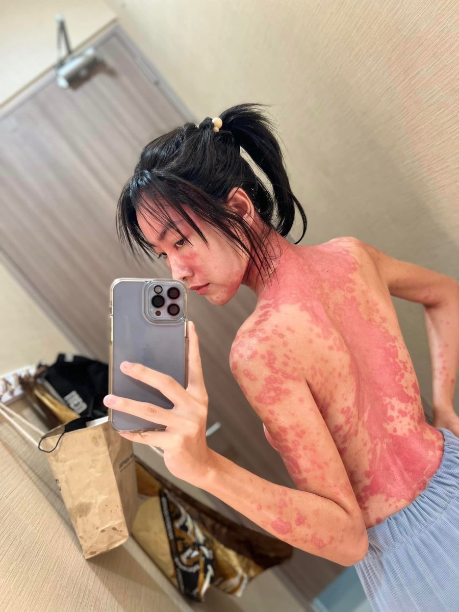 สาวแคดดี้ แชร์ประสบการณ์ชีวิต ป่วยเป็นโรคแพ้ภูมิตัวเอง