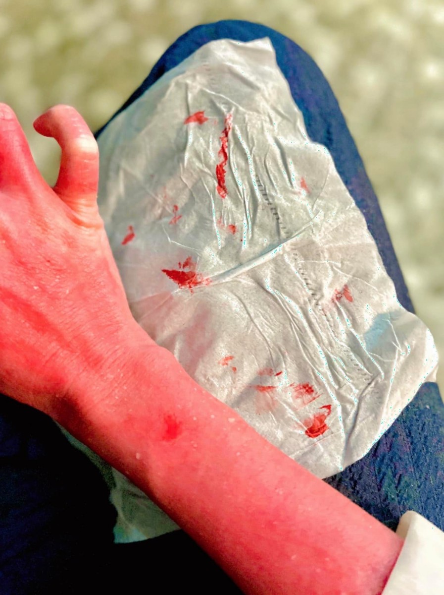 สาวแคดดี้ แชร์ประสบการณ์ชีวิต ป่วยเป็นโรคแพ้ภูมิตัวเอง