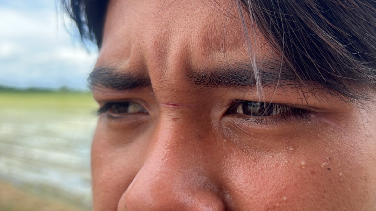 นนทบุรี เตือนภัย หนุ่มโรงงานโพสต์ หลังถูกเส้นเอ็นตกปลาเกี่ยวหน้า หวิดตาบอด