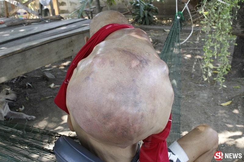 ครูเล็ก ป่วยมะเร็ง