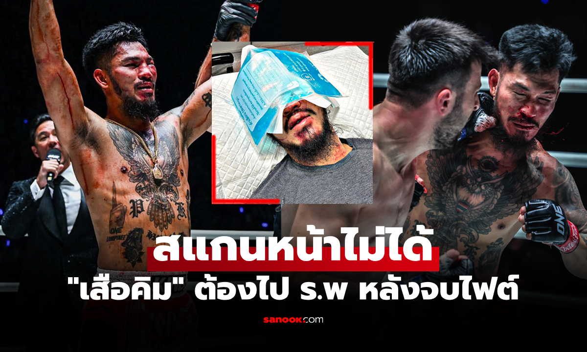 ต้องแลกมา! เปิดสภาพใบหน้า "เสือคิม" หลังบู๊เดือดพลิกเฮแต้ม "ซายิก" ศึก ONE