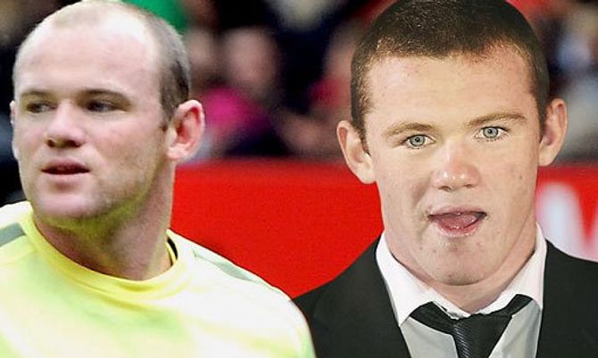 รูนีย์พบหมอรักษาอาการผมร่วงกลัวหัวล้าน