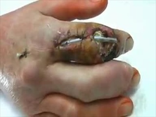 ผ่าตัดนิ้วมือผู้ป่วยโรคเกาต์ สยอง!!