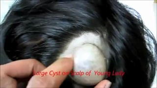 ผ่าก้อนซีตส์ที่หัว..แหมบีบซะ!!