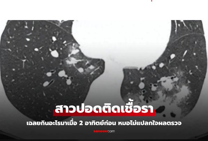 สาวปอดติดเชื้อรา เฉลยกินอะไรมาเมื่อ 2 อาทิตย์ก่อน หมอไม่แปลกใจผลตรวจ