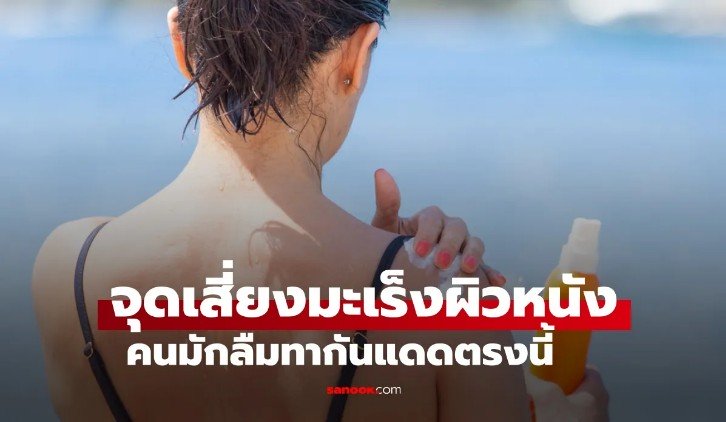 แพทย์ชี้ จุดนี้ บนร่างกาย เสี่ยงมะเร็งผิวหนังมากที่สุด