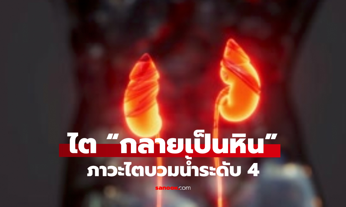 ไตกลายเป็นหิน ต้องตัดทิ้ง! หมอชี้สาเหตุ ไม่ได้มาจากอาหาร