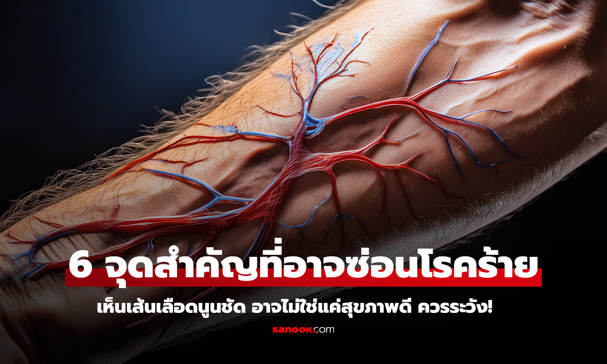 เส้นเลือดนูนชัด 6 จุดบนร่างกาย สัญญาณเตือนโรคที่คุณไม่ควรมองข้าม