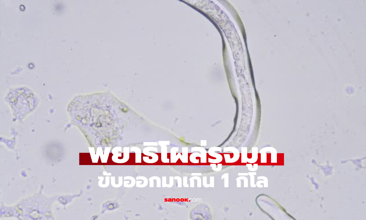 ไวรัลช็อก! พยาธิโผล่จมูกเด็ก ยาวเกิน 1 กิโลฯ จนหมอช่วยไม่ไหว